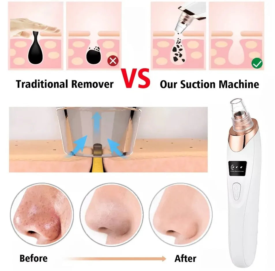 5-in-1 Rechargeable Blackhead Remover Machine – Facial Pore Vacuum Suction Cleaner with 5 Interchangeable Heads